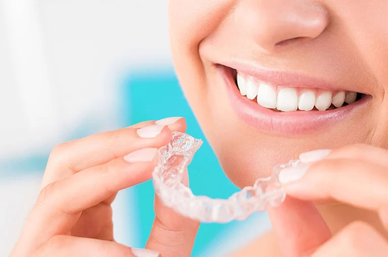 Aligner Trasparenti - Invisalign