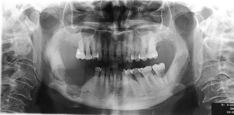 osteonecrosi dei mascellari